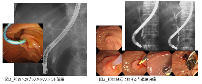 ERCP02