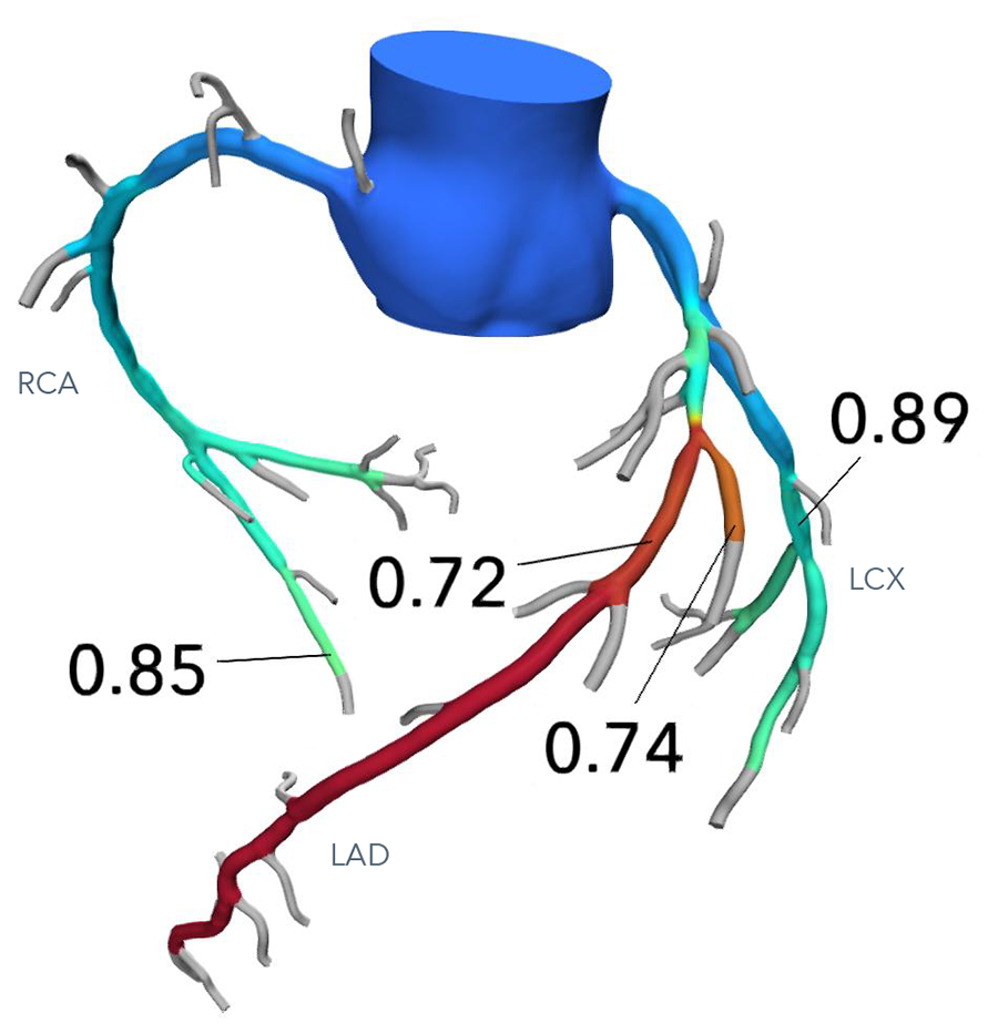 個々の冠動脈固有の機能的虚血評価が可能になった図