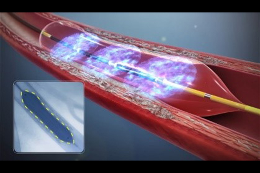 IVLカテーテルの図