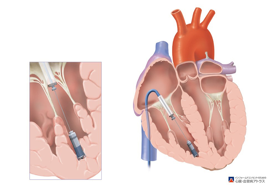 直接心臓に留置するリードレスペースメーカーの図
