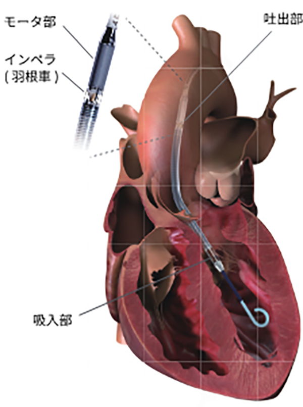 カテーテル型の補助人工心臓「IMPELLA」の図