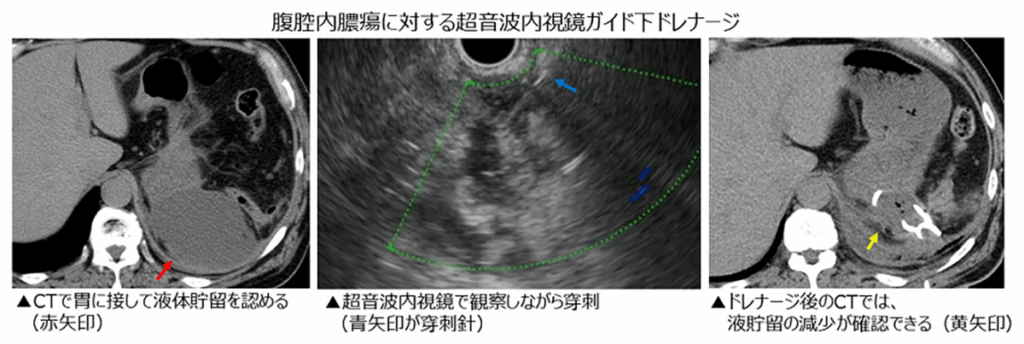 腹腔内膿腫に対する超音波内視鏡ガイド下ドレナージの画像