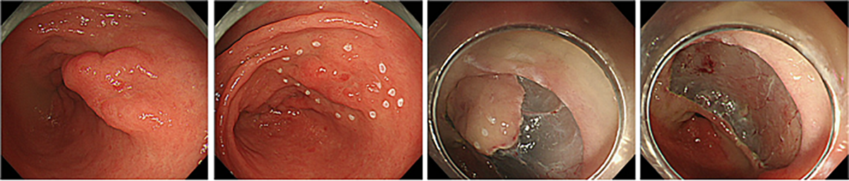 食道や胃の早期がんに対する内視鏡治療の画像