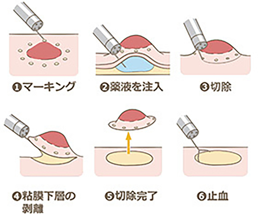 内視鏡的粘膜下層剥離術の流れの図