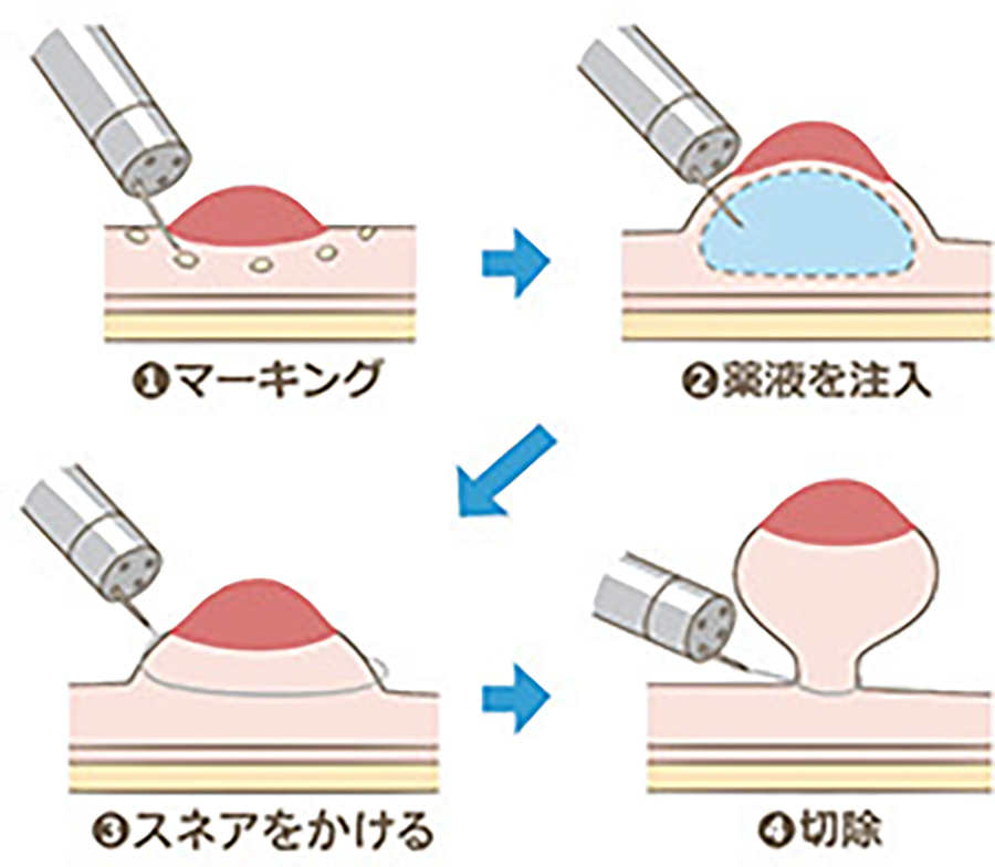 内視鏡的粘膜切除術の流れの図
