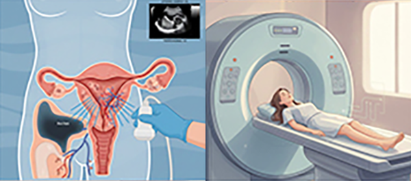 子宮体がんの診断方法の図